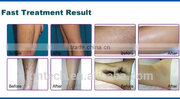 CE ISO Approved Portable Medical 808nm Diode Laser Hair Removal Machine With 160J/cm3 Energy photo-4