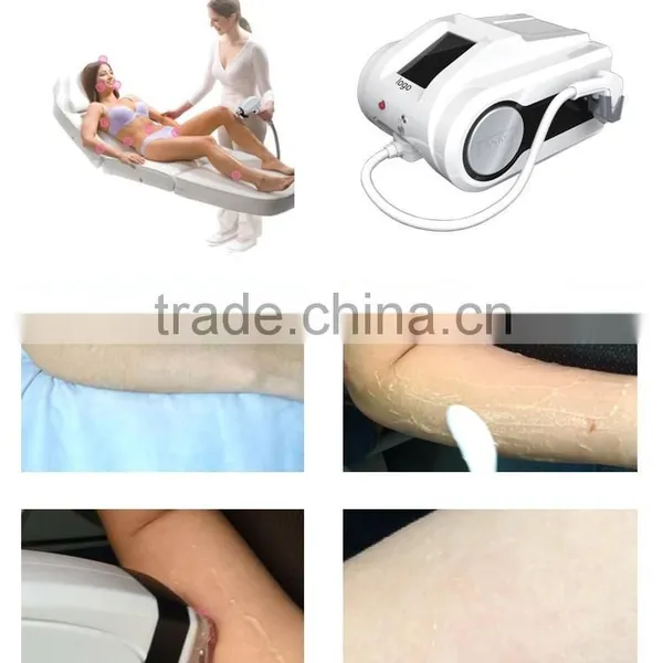 Back / Whisker Big Spot Size Portable Diode Laser 810 Hair Removal Machine/ Laser Hair Removal Machine Men Hairline photo-6