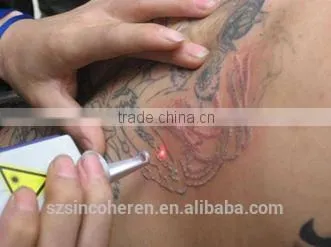 nd Yag Laser Tatoo Removal Machine Carbon Peeling Treatment for Skin Rejuvenation photo-3