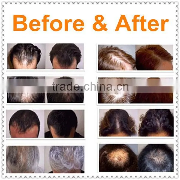 Hair Growth Electric Scalp Stimulator Device photo-6
