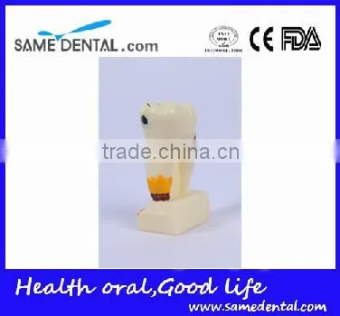Dental Model School Teaching Dental Eduction Assitant No. DEA-15 4 Times Integrated Pathology Model photo-2