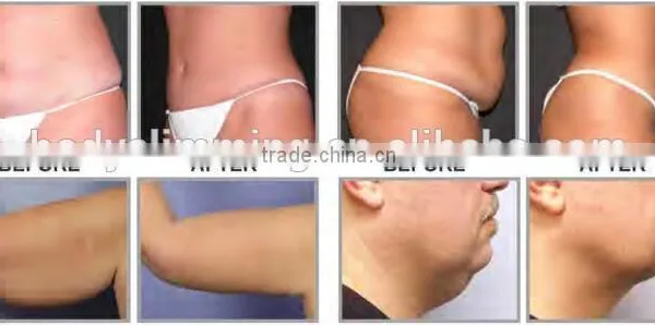 Quick Slim! Home Use Lipo Laser Slimming Machine With FDA Approved photo-6