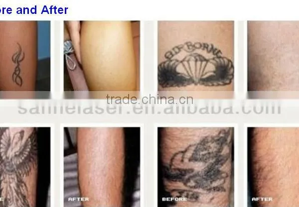 OEM Service Beauty Device 1064 nm 532nm Nd:yag Laser Q- Switched Nd YAG Laser Tattoo Removal/pigmentation/freckle Remove Machine photo-4