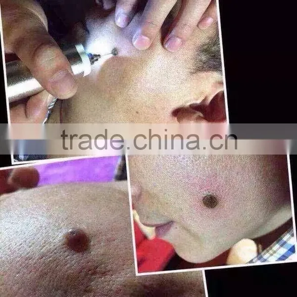 High Frequency Spot Removal Pen Speckle Removal photo-2