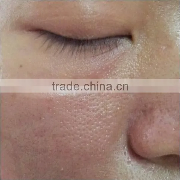 Medical Skin Tightening Fractional Co2 Laser Equipment Skin Treat Telangiectasis Age Spot Removal Rejuvenation Co2 Laser Scar Removal Acne Treatment Face Lifting photo-6