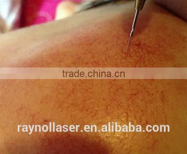Smart Mini Spider Vein Removal Machine 30MHz RBS photo-6
