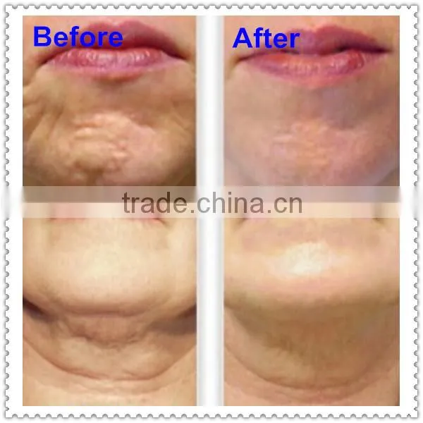 Professional Shr Ipl Hair Removal Machine photo-6