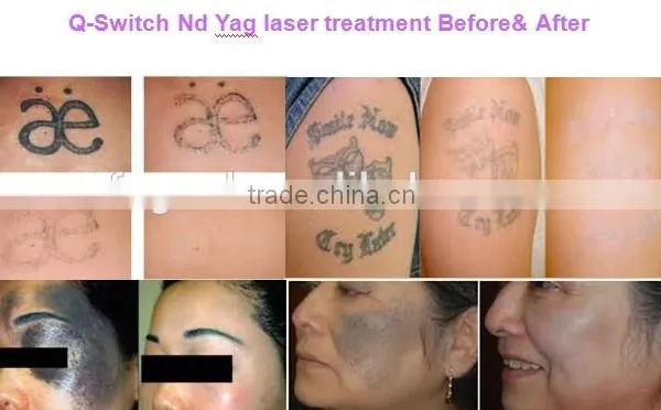 2016 New Year Best Q-Switch nd Yag Laser Tattoo Removal Treatment Machine photo-5