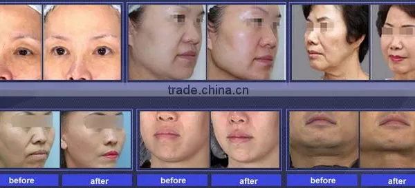 2016 Hifu Face Lifting Wrinkle No Pain Removal Beauty Machine HIFU U-one Eye Lines Removal photo-6