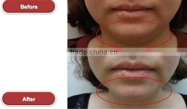 Portable New 2016 Hot Sale Hifu Anti-aging High Frequency Machine For Acne Skin Care Ultrasound Face Lift Machine Face Lifting photo-6