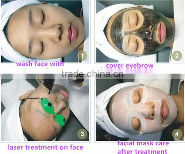 nd Yag Laser With Black Tip for Skin Whitening Laser Carbon Treatment photo-2