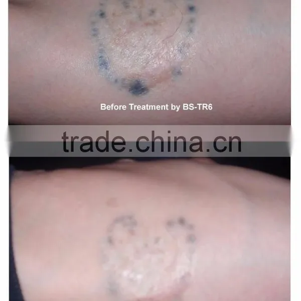 Varicose Veins Treatment Q Switch Nd Yag 1 HZ Laser Machine For Tattoo Removal Vascular Tumours Treatment photo-4