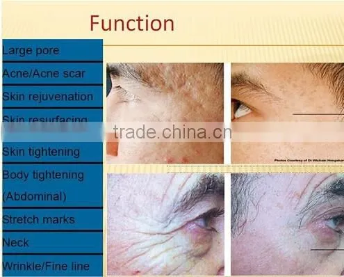 Radiofrequency Micro Needle rf Fractional&fractional rf Microneedle Machine photo-6