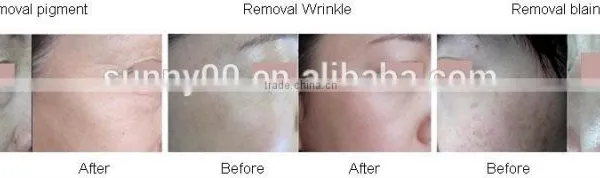 Hot Selling!! Fractional Co2 Laser For Superfacial Acne Remove Neoplasms Scar Surgery Equipment With Medical Ce And Iso Eliminate Body Odor photo-3