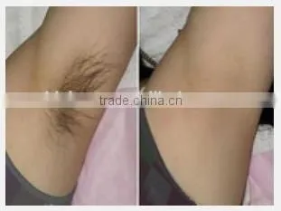 Supply Medical Affordable Permanent Hair Removal / at Home Laser Hair Removal Machines Keyword photo-6