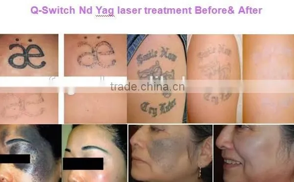 2016 Q-Switch Nd Yag Laser Machine 0.5HZ Tattoo And Pigments Removal Laser Machine Q Switch Laser Tattoo Removal photo-6
