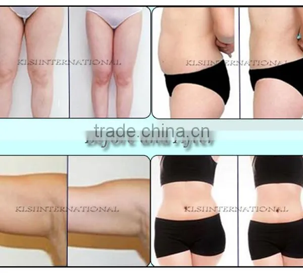 Fat Melting Multifunction Cavitation Vacuum Slimming 2000 Shots Double Chin Removal Machine/home Use Hifu Slimming Machine Hips Shaping photo-6