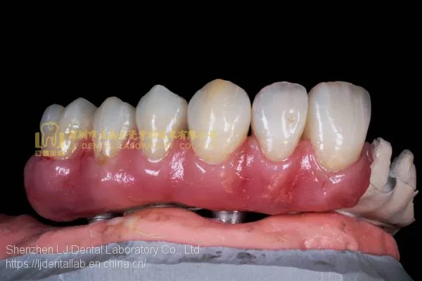 Dental Implant Prosthesis, Implant Denture, Dental Prosthesis, Laboratoire Dentaire, Dentallabor, Laboratorio Dental, Dental Laboratory, Shenzhen LJ Dental Lab China photo-4