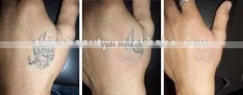 2016 Most Effective Best Q Switch Nd Yag Laser 1000W Machine For Tattoo Removal Birthmark Removal And Pigmentation Treatment 1-10Hz photo-6