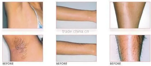 HOT Low Price Depitime Hair Removal/virgin Hair Removal/cheapest IPL Hair Removal photo-6