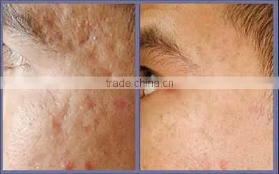 2016 Lowest Distributor Price: Super Pulse Co2 Laser for Skin Refreshing Scar Remov for Acne Scars Treatment , Burn Debridement photo-3