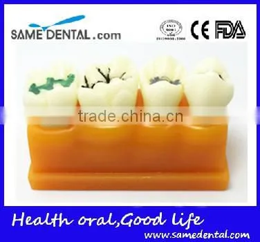 Pit and Fissure Model Dental Eduction Assistant No. DEA-19 photo-2