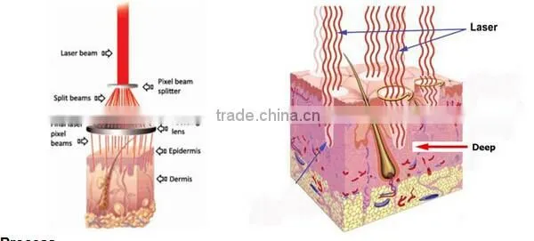 Ultra Pulse Laser Surgery Treatments Vaginal Mucosa Tightening Fractional Co2 Laser photo-5