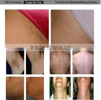 2016 Hot Sale 808nm Diode Laser Hair Removal Machine/hair Removal Speed 808 photo-6