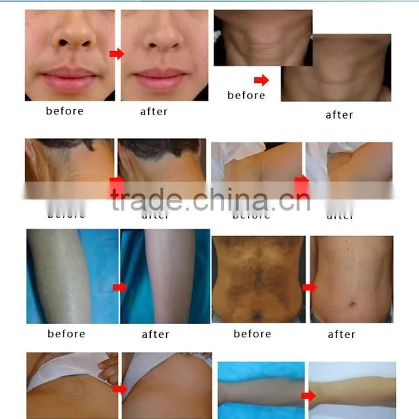 Abdomen Professional Diode Laser 810 Hair Removal Machine Whole Body photo-6