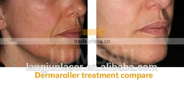 Proffesional 540 Needles Stainess Steel and Titanium Derma Roller photo-4