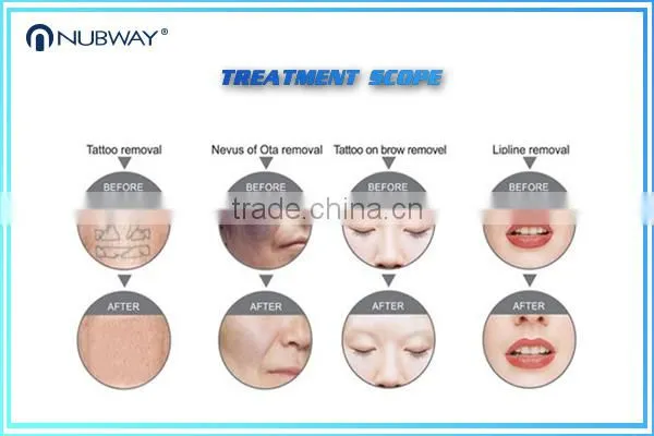 Distribution Price Picosure Laser q Switched nd Yag Laser Tattoo Removal With CE photo-2