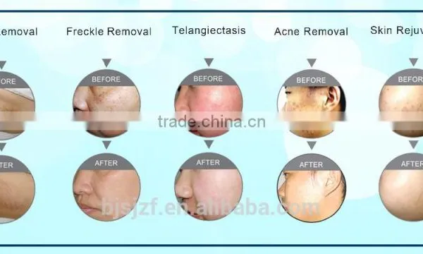 SH-1 2016 Newest Products Male Hair Removal Beauty Equipment With Diode Device photo-6