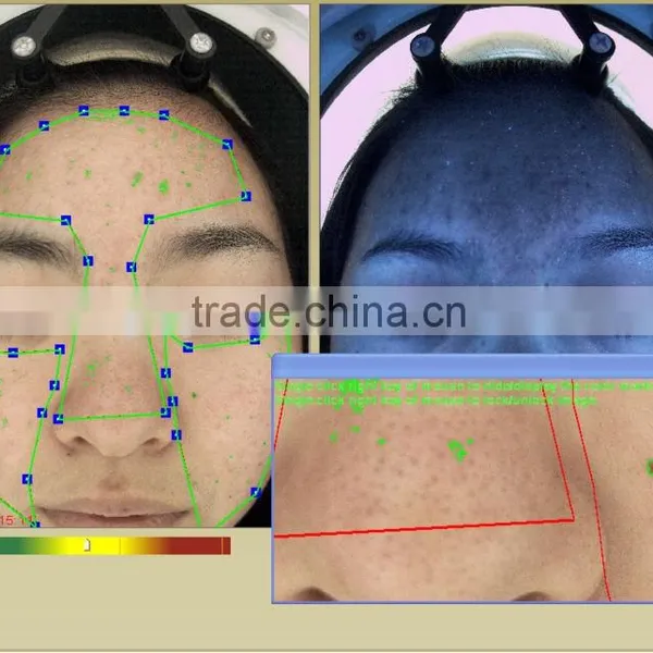 Auto Facial Skin Portable Analyzer With Customer Datebase and 10 Mega Pixels Camera photo-6