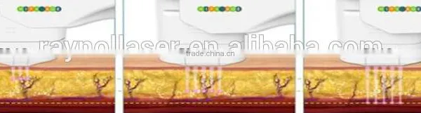 Hot Sale HIFU Ultrasound Machine For 1.0-10mm Skin Tightening High Intensity Focused Ultrasound photo-3