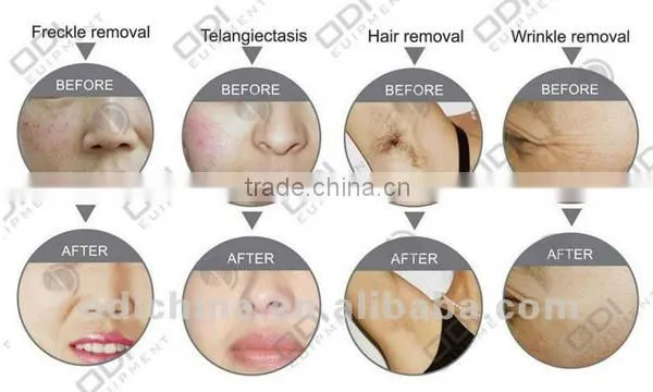 OD-A900 Beauty Machine for Skin Rejuvenation Fast Hair Removal Portable Ipl photo-4