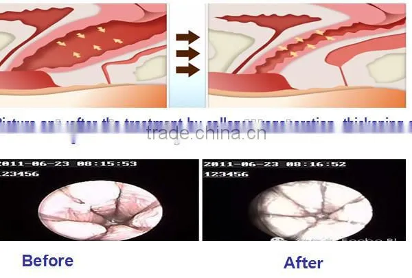 100um-2000um CO2 Fractional Laser Scar Removal Skin Resurfacing Fractional Co2 Laser Equipment Eye Wrinkle / Bag Removal photo-3