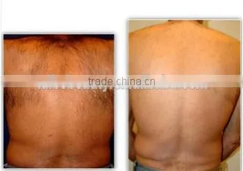 Portable Ipl Laser Hair Removal Machine photo-6