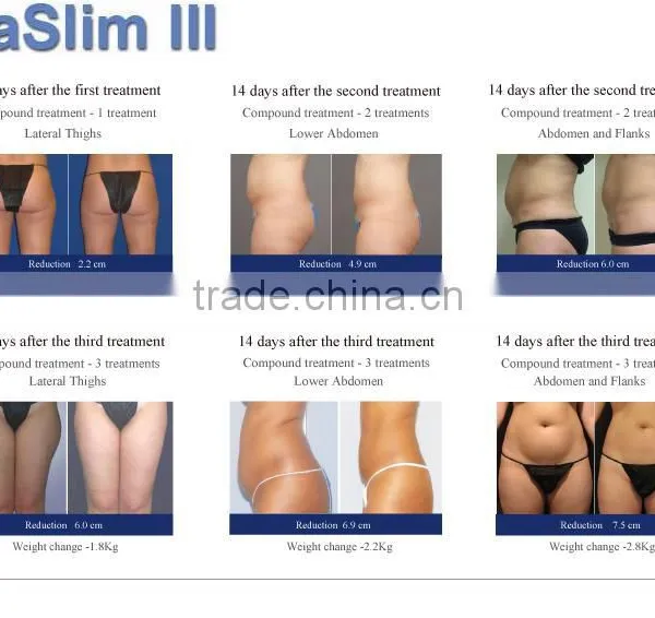 Best Selling Products VelaSlim Skin Tightening Radio Frequency Machine photo-2