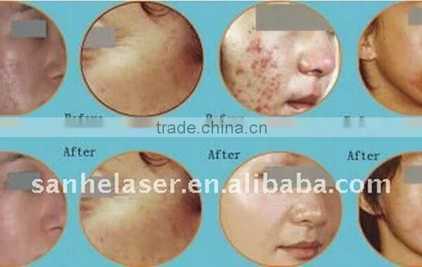 Best Selling Products !!co2 Fractional Clinic Co2 Fractional Equipment Vaginal Tightening Sanhe photo-6