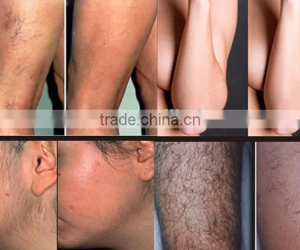 Hair Removal and Skin Rejuvenation Beauty Device With 2 Lamps Under Medical CE photo-3