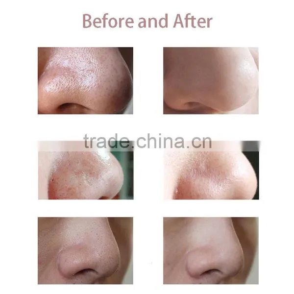 Micro Machine Facial Cleansing Portable Dermabrasion Machine for Blackhead Removal photo-6