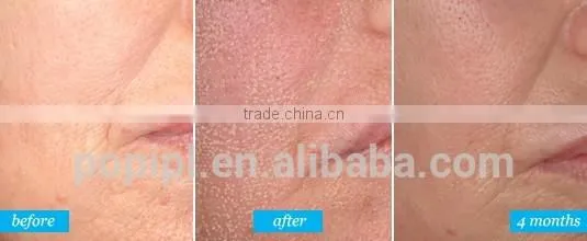 480-1200nm China Manufacturer Best Price Fractional Co2 Skin Redness Removal Renewing Laser Equipment Co2 Laser Scar Removal 1ms-5000ms photo-4