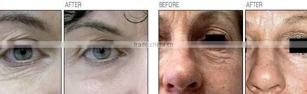 30W RF Tube Medical Laser New System Co2 Cutting & Fractional Co2 & VRL Vaginal Tightening Laser photo-5