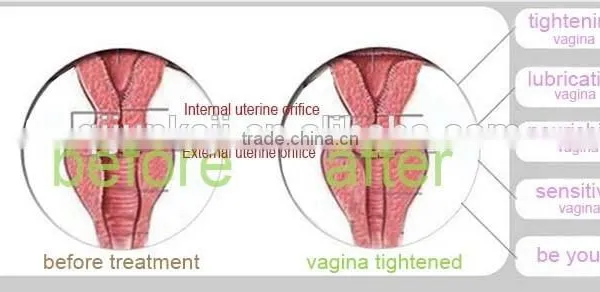 15W(20W) Fractional CO2 Laser Machine Surgical Treatment 8.0 Inch Vaginal Tightening Better Than Vaginal Lubricants photo-5
