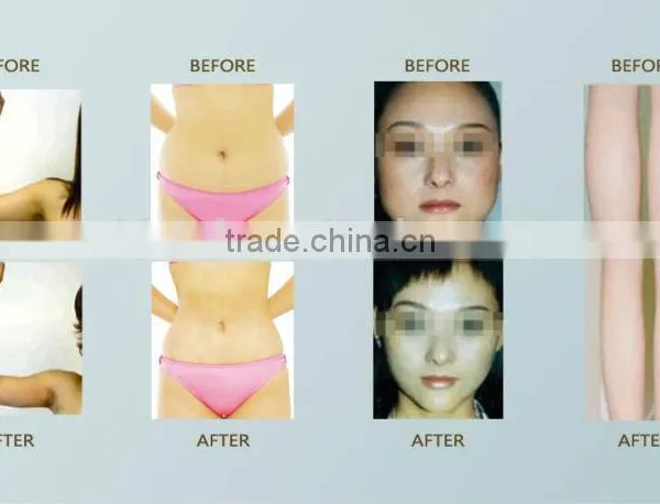 Cryolipolysis Weight Loss Machine photo-4
