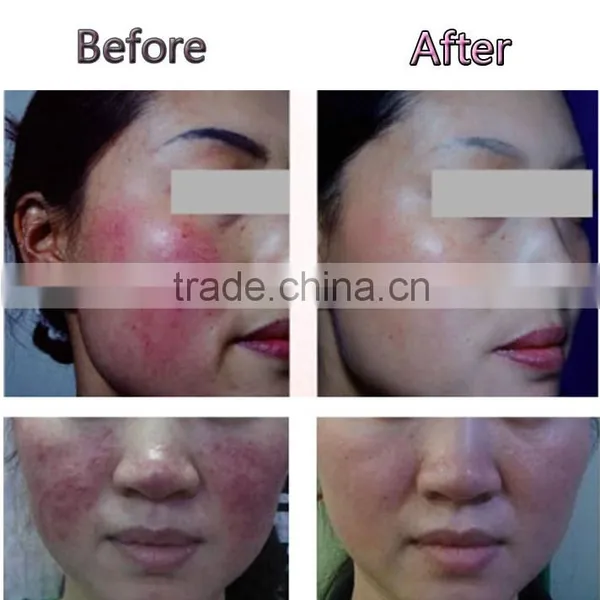 High Quality With CE Approval Portable Laser Vascular Remove Machine photo-6