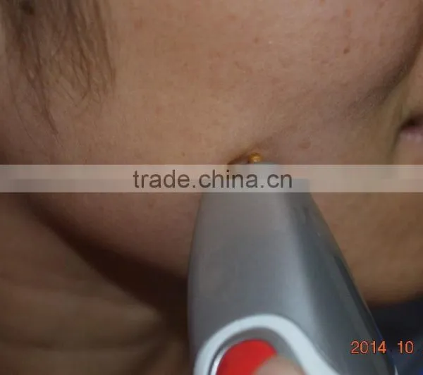 Reduction of Wrinkle, Dark Color, Puffy Skin Remage Device photo-5