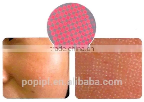 Laser Resurfacing photo-3
