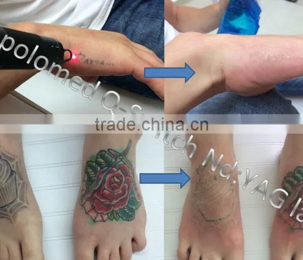 Beautician Use Nd Yag Laser Tattoo Removal Laser for Sale photo-5