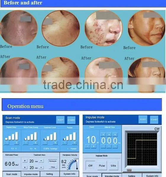 CO2 Fractional Laser ( RF Tube Made in USA )/ Fractional Co2 Laser Beauty Device photo-6